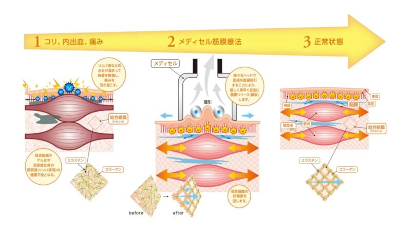筋膜リリース、むくみ